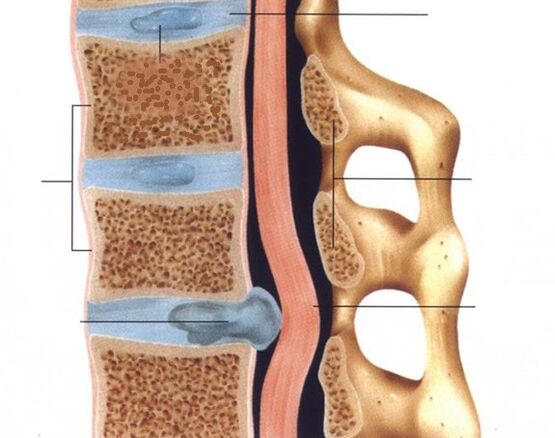 Awọn Hernias wa ni kede