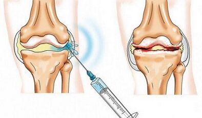 Ina ti apapọ orokun fun arthrosis