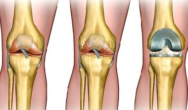 Ìyí ti idagbasoke ti arthrosis ti orokun orokun
