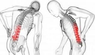 Mering Herstin - ilolu pẹlu osteochondrosis