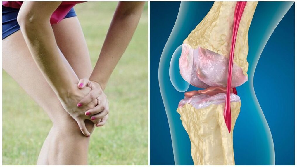Awọn ami aisan ti arthrosis