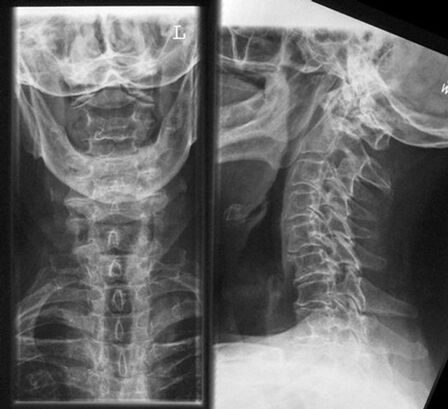 AMACICE XACly - ọna ti ayẹwo ti osteochondrosis