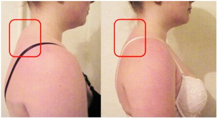 Ibiyi ti roller ti o wa pẹlu osteochondrosis