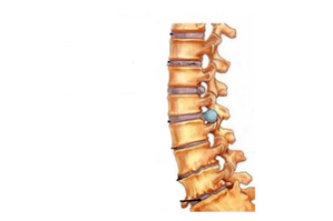 Bibajẹ si ọpa ẹhin pẹlu osteochondrosis