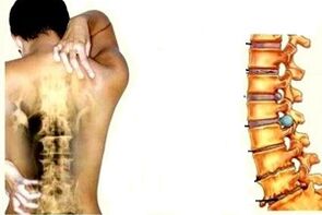 Pada irora ni awọn ipo oriṣiriṣi ti idagbasoke ti osteochondrosis