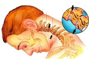 Pinching ti nafu ni ọpa ẹhin pẹlu osteochondrosis