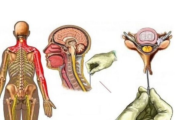 Itoju ti osteochondrosis ti o jẹ pẹlu ẹjẹ