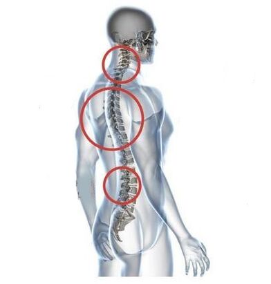 awọn aaye ti osteoclondrosis ọpa-ẹhin