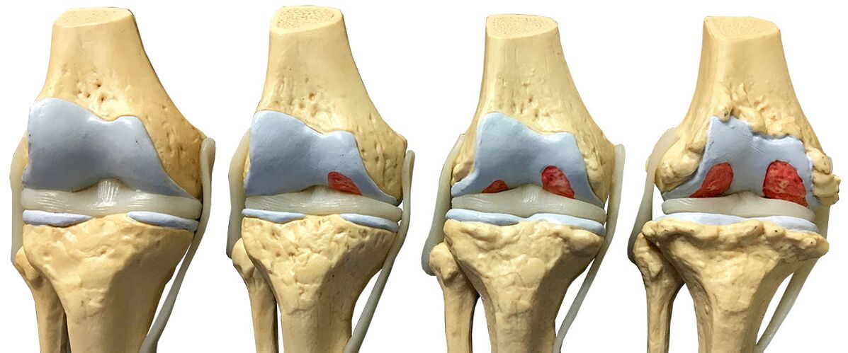 awọn ipele ti arthrosis