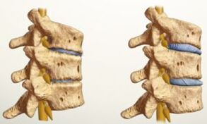 Kini osteochondrosis dabi