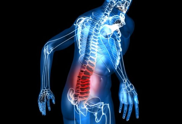 Kini osteochondrosis lumbar