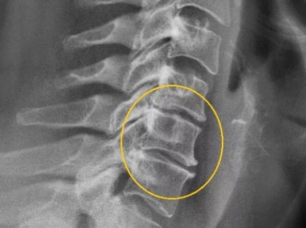 Osteochondrosis ti ọpa ẹhin ara lori x-ray