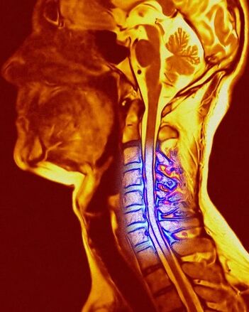 chondrosis cervical